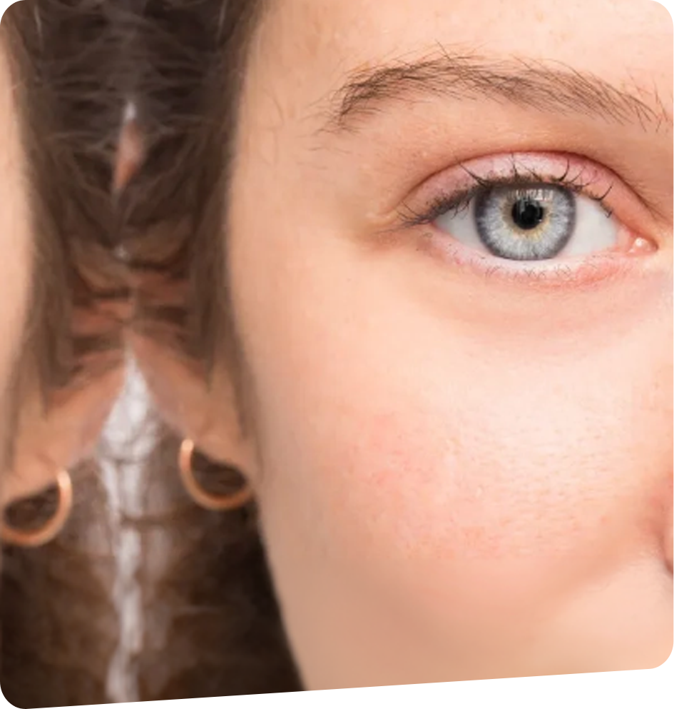 Acide-Hyaluronique-foch-vision-bayonne-tarnos-capbreton-dax-2