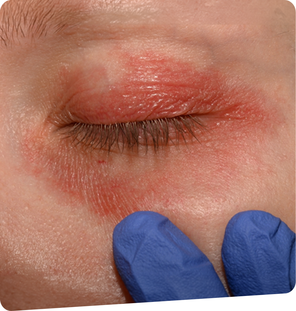 Blepharite-soins-de-paupieres-et-lumiere-pulsee-foch-vision-bayonne-tarnos-capbreton-dax-1