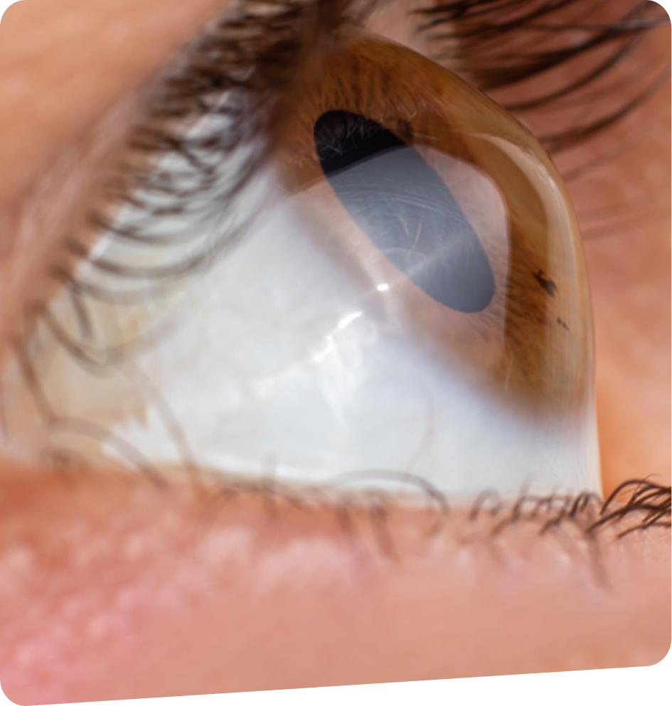 Keratocone-foch-vision-bayonne-tarnos-capbreton-dax-2