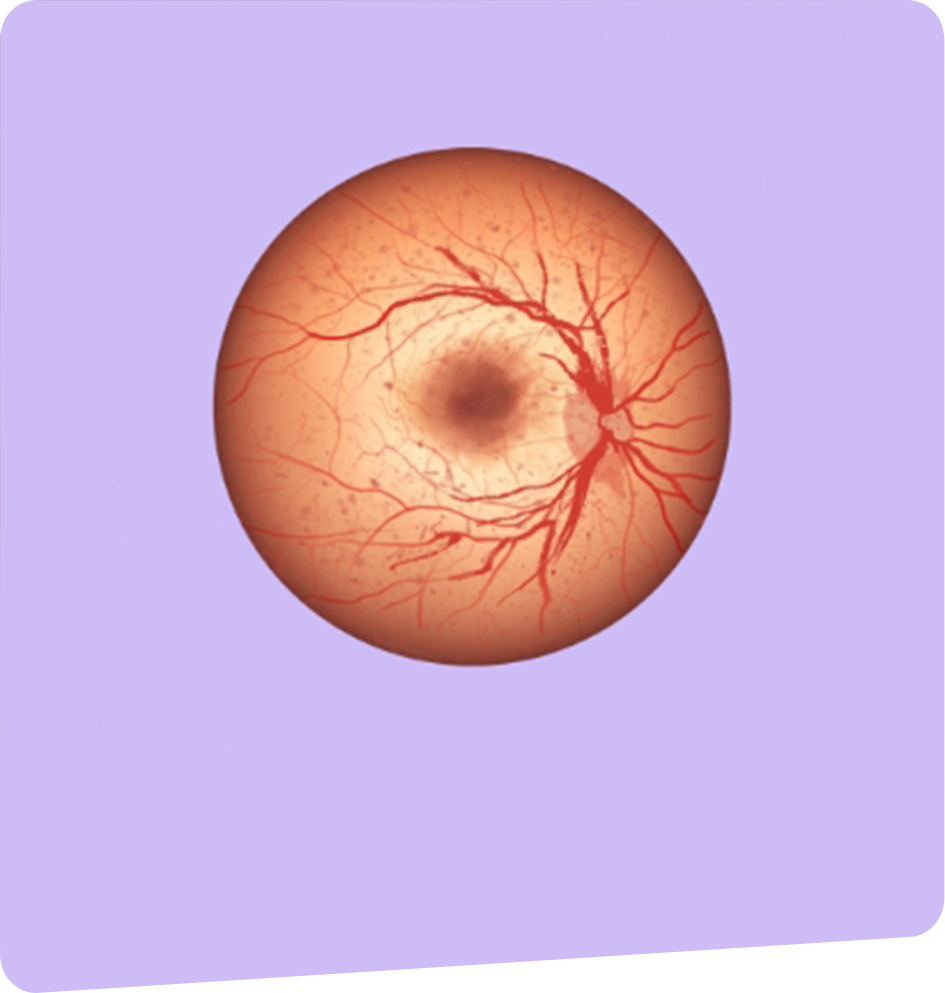 Occlusion-vasculaire-foch-vision-bayonne-tarnos-capbreton-dax-2