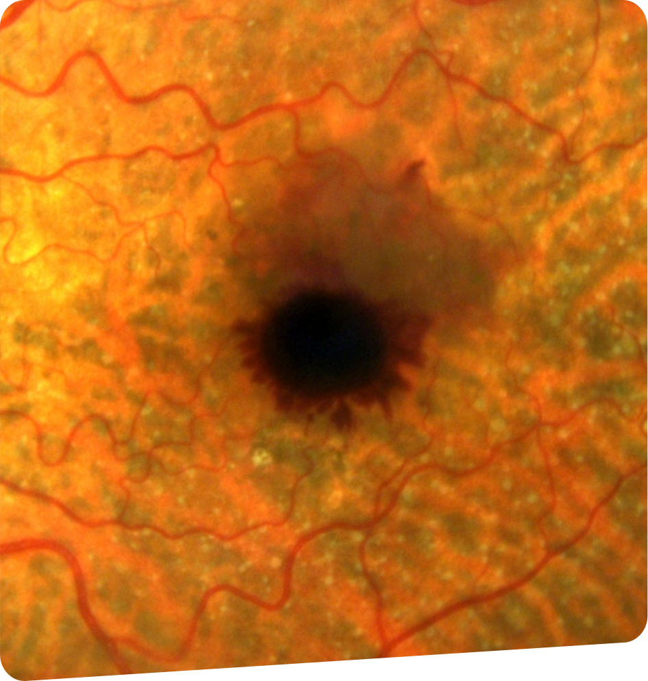 Pathologie rétinienne-foch-vision-bayonne-tarnos-capbreton-dax-2