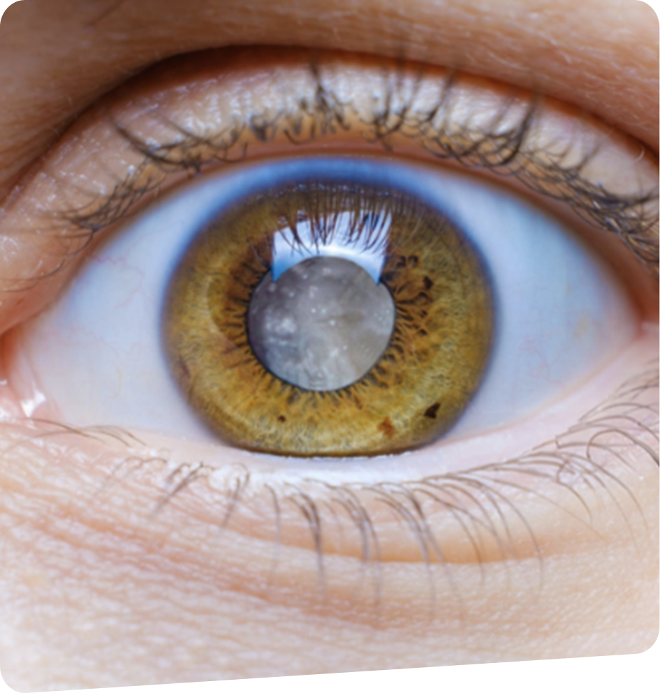 chirurgie-de-la-cataracte-foch-vision-bayonne-tarnos-capbreton-dax-2