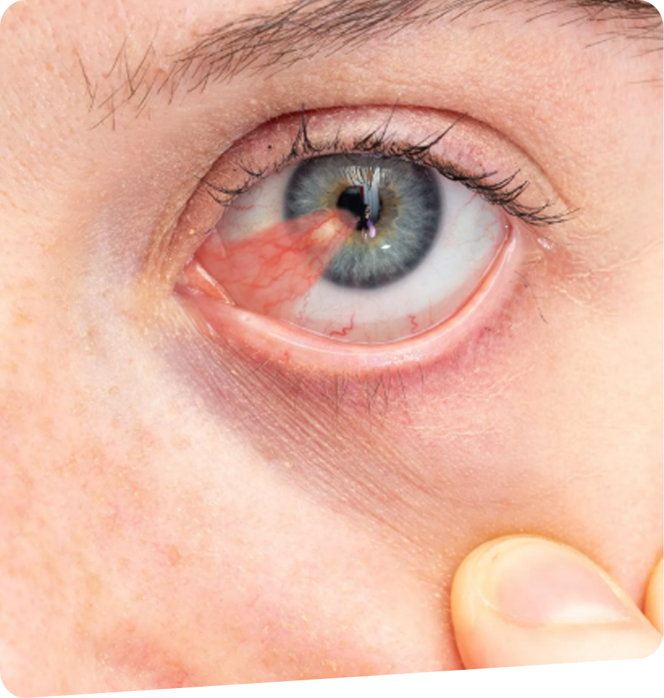 traitement-Pterygion-foch-vision-bayonne-tarnos-capbreton-dax-2